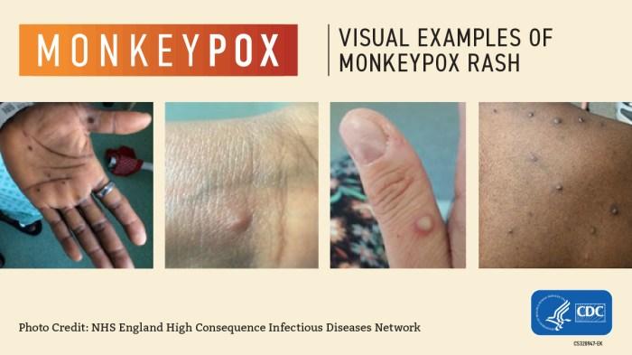 Monkeypox: Ancaman Baru bagi Kesehatan Global