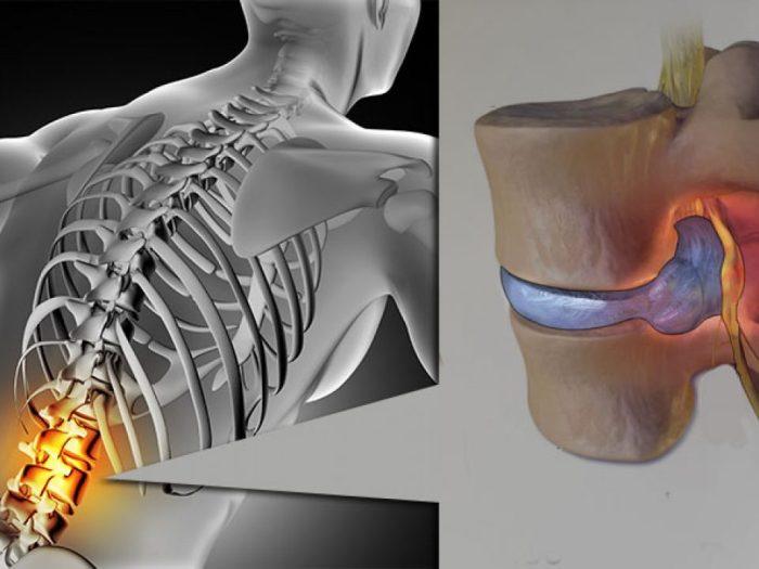 Kode ICD untuk Hernia Nukleus Pulposus: Panduan Lengkap