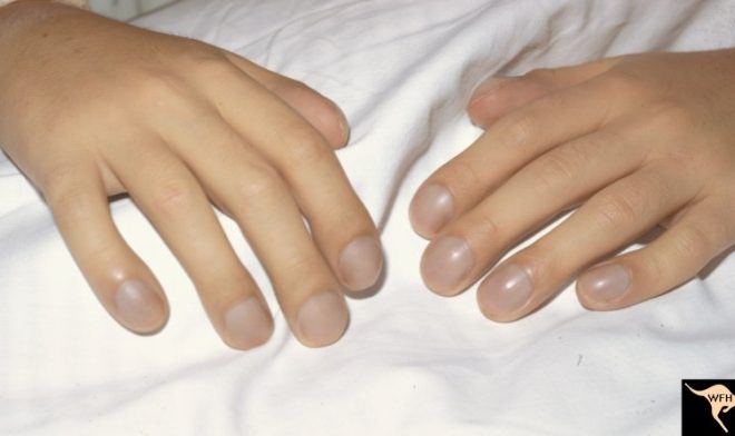 Attack fingernails myocardial infarction gout arthritis include