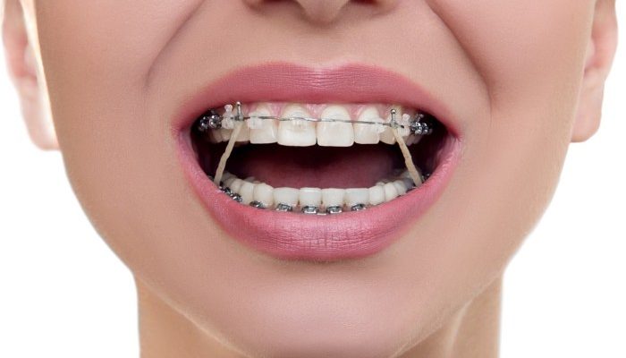 7 Warna Karet Behel yang Bagus untuk Perempuan Saat Tersenyum