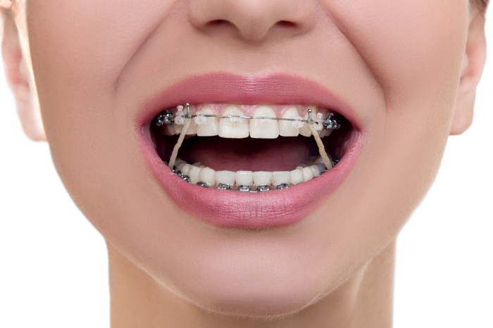 7 Warna Karet Behel yang Bagus untuk Perempuan Saat Tersenyum