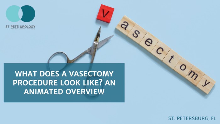 Vasectomy benefits getting men Apa Itu Vasektomi? Ini Pengertian, Prosedur, dan Manfaatnya