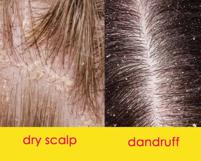 Dandruff get rid fast way remove minute trick fastest minutes dry 8 Cara Menghilangkan Ketombe Kering agar Kulit Kepala Lebih Sehat