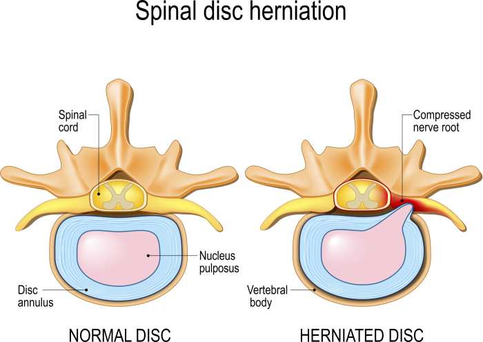Disc herniation spine spina disk etapper medicinska illustrationen eps anatomie HNP: Definisi, Gejala, Penyebab, dan Cara Mengatasinya