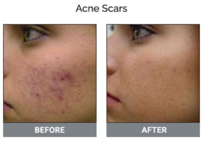 21 Skincare Penghilang Bekas Jerawat Paling Ampuh 2 21 Skincare Penghilang Bekas Jerawat yang Paling Ampuh