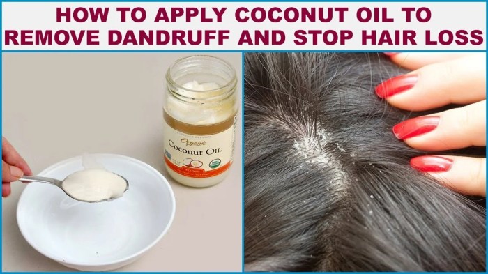 Dandruff rid naturally Dandruff rid naturally